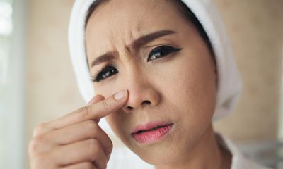 Asam Salisilat Asam Glikolat Mengontrol Minyak dan Mencegah Kulit Berjerawat